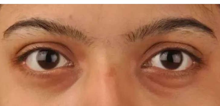 去黑眼圈的眼霜哪款好(黑眼圈用什么眼霜最好)(11)